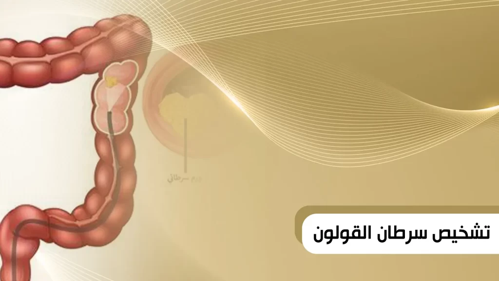 تشخيص سرطان القولون