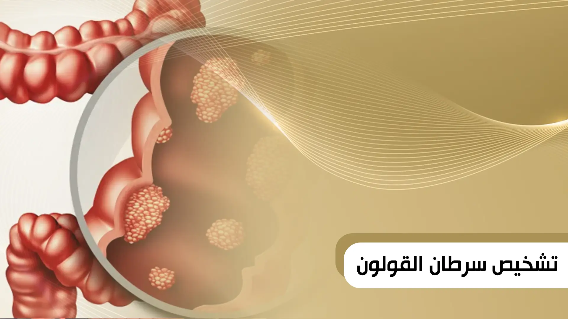 تشخيص سرطان القولون