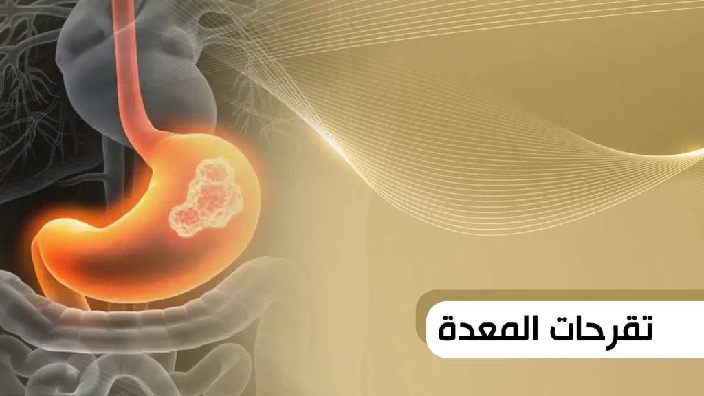 تقرحات المعدة