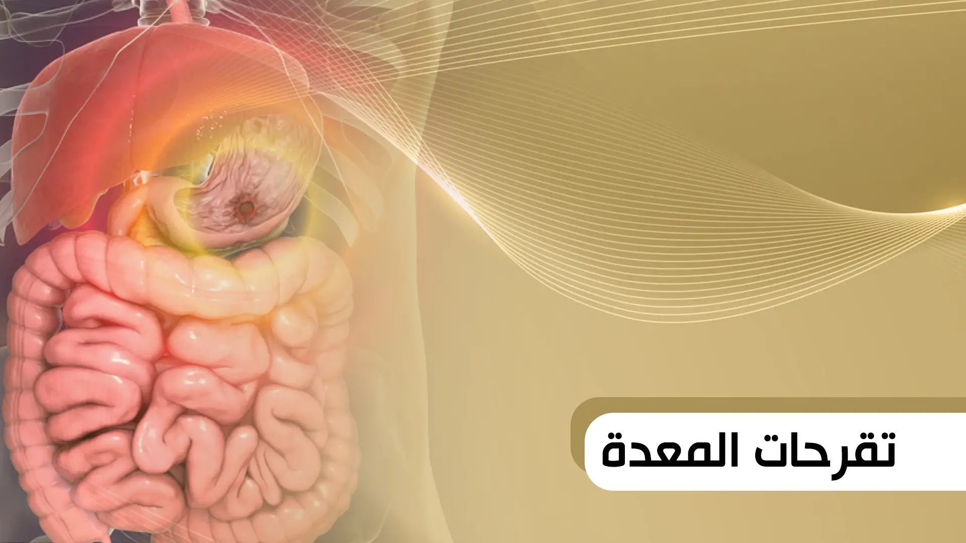 تقرحات المعدة