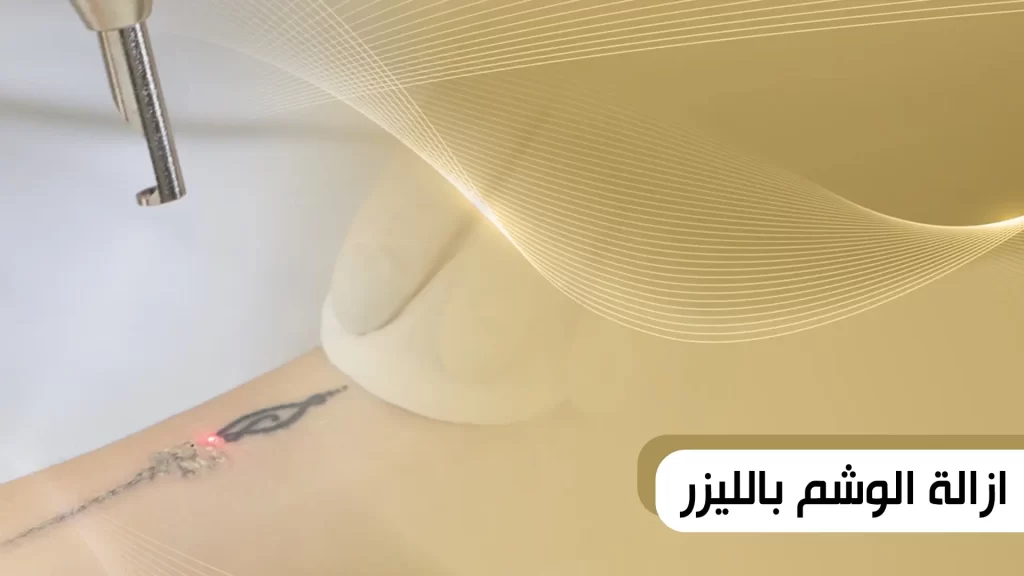 ازالة الوشم بالليزر